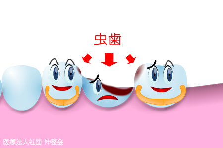 【図解】虫歯のブリッジ治療で見落としがちな注意すべき点