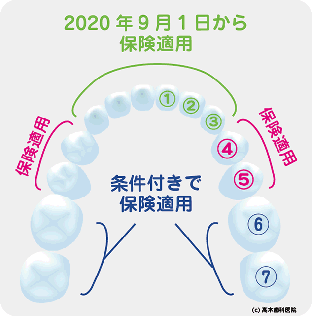 Cad Cam ハイブリッド セラミック冠 保険適用 高木歯科医院