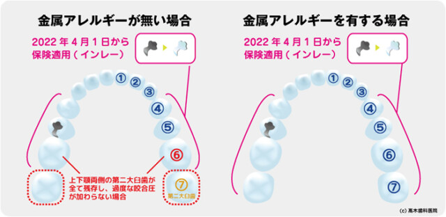 CAD/CAM冠(キャドカム冠/保険適用の白い歯)-東京